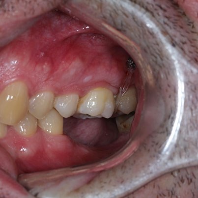 Интрузия зубов с помощью ортодонтических микроимплантатов